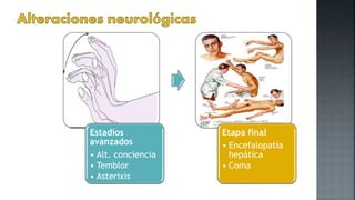 Estadíos
avanzados
• Alt. conciencia
• Temblor
• Asterixis
Etapa final
• Encefalopatía
hepática
• Coma
 