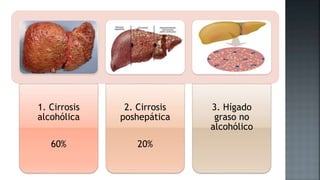 1. Cirrosis
alcohólica
60%
2. Cirrosis
poshepática
20%
3. Hígado
graso no
alcohólico
 