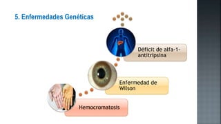 5. Enfermedades Genéticas
Hemocromatosis
Enfermedad de
Wilson
Déficit de alfa-1-
antitripsina
 