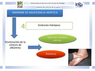 SÍNDROME DE INSUFICIENCIA HEPÁTICA
Síndrome hidrópico
Disminución de la
síntesis de
albúmina
Anasarca
 