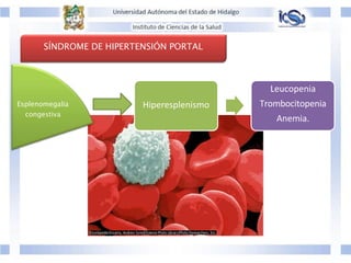 Hiperesplenismo
Leucopenia
Trombocitopenia
Anemia.
SÍNDROME DE HIPERTENSIÓN PORTAL
Esplenomegalia
congestiva
 