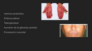 Ictericia esclerótica
Eritema palmar
Telangiectasia
Aumento de la glándula parótida
Emaciación muscular
 