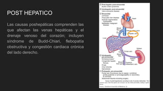 POST HEPATICO
Las causas poshepáticas comprenden las
que afectan las venas hepáticas y el
drenaje venoso del corazón; incluyen
síndrome de Budd-Chiari, flebopatía
obstructiva y congestión cardiaca crónica
del lado derecho.
 