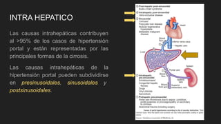 INTRA HEPATICO
Las causas intrahepáticas contribuyen
al >95% de los casos de hipertensión
portal y están representadas por las
principales formas de la cirrosis.
Las causas intrahepáticas de la
hipertensión portal pueden subdividirse
en presinusoidales, sinusoidales y
postsinusoidales.
 