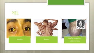 PIEL
Ictericia Prurito
Arañas vasculares
abdominales
 