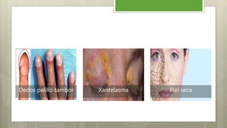 Dedos palillo tambor Xantelasma Piel seca
 