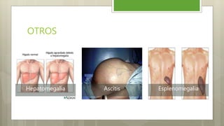 OTROS
Hepatomegalia Ascitis Esplenomegalia
 