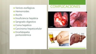 COMPLICACIONES Varices esofágicas
 Hemorroides
 Ascitis
 Insuficiencia hepática
 Sangrado digestivo
 Coma hepático
 Carcinoma hepatocelular
 Encefalopatía
portosistémica
 