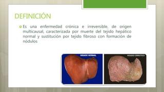 DEFINICIÓN
 Es una enfermedad crónica e irreversible, de origen
multicausal, caracterizada por muerte del tejido hepático
normal y sustitución por tejido fibroso con formación de
nódulos
 