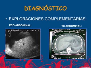 DIAGNÓSTICO
• EXPLORACIONES COMPLEMENTARIAS:
ECO ABDOMINAL: TC ABDOMINAL:
 