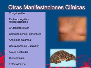 Otras Manifestaciones Clínicas
• Coagulopatías
• Esplenomegalia e
Hiperesplenismo
• CA Hepatocelular
• Complicaciones Pulmonares
• Angiomas en araña
• Contracturas de Dupuytren
• Atrofia Testicular
• Ginecomastia
• Eritema Palmar
 