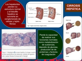 Los hepatocitos
pierden su
estructura normal
y el lobulillo
hepático se
convierte en
conglomerado de
células y tejido
fibroso
Pierde la capacidad
de realizar sus
funciones normales
como metabolización
de sustancias,
deposito de glucosa,
producción de de
proteínas y factores
de coagulación
CIRROSIS
HEPÁTICA
 