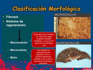 Clasificación Morfológica
• Fibrosis
• Nódulos de
regeneración
– Macronodular
– Micronodular
– Mixto
El tamaño de los nódulos
es >3mm los cuales
engloban lobulillos
hepáticos,, ocurre por lo
general en la etiología
viral
Los nódulos de
regeneración son
pequeños <3m no
contiene elementos
portales y ocurre por lo
general en la etiología
alcohólica
 
