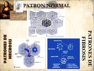 PATRONESDE
NECROSIS
PATRONESDE
FIBROSIS
PATRON NORMAL
 