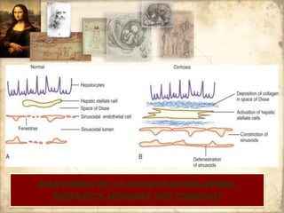 ANATOMIA DE LA MICROVASCULATURA
HEPATICA NORMAL VRS CIRROSIS
 