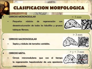 CLASIFICACION MORFOLOGICA
• CIRROSIS MICRONODULAR
– Pequeños nódulos de regeneración con
deseestructuración de todos los lobulillos y gruesos
tabiques fibrosos.
• CIRROSIS MACRONODULAR
– Septos y nódulos de tamaños variables.
• CIRROSIS MIXTA:
– Cirrosis micronodulares que con el tiempo
la regeneración hepatocelular da una apariencia
macronodular.
< 3 mm
> 3 mm
> y < 3 mm
 