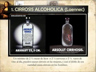 1. CIRROSIS ALCOHOLICA (Laennec)
Un mínimo de 2 ½ onzas de licor o 2 ½ cervezas o 2 ½ vasos de
vino al día, pueden causar cirrosis en las mujeres, y casi el doble de esa
cantidad causa cirrosis en los hombres.
 