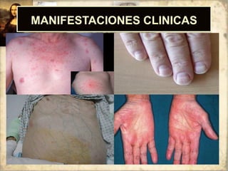 MANIFESTACIONES CLINICAS
 