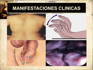 MANIFESTACIONES CLINICAS
 