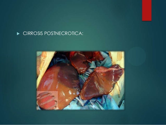 Cirrosis hepatica Cirrosis hepatica
