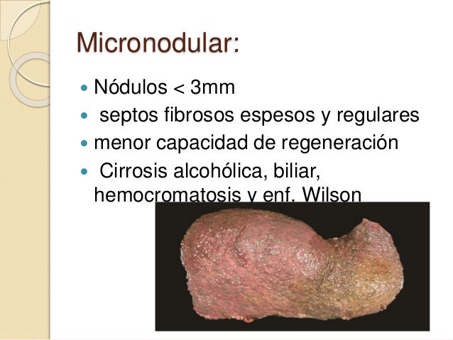 Cirrosis hepatica Cirrosis hepatica