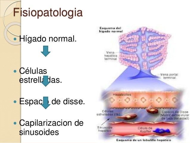 Cirrosis hepatica Cirrosis hepatica