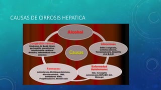 CAUSAS DE CIRROSIS HEPATICA