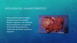PATOLOGIA DEL HIGADO CIRROTICO
• Macroscópicamente el hígado
presenta superficie nodular,
Bordes irregulares, con aumento
de la consistencia y en general
atrofia del lóbulo derecho e
hipertrofia del lóbulo caudado e
izquierdo