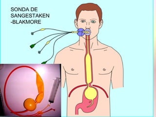 mbf
SONDA DE
SANGESTAKEN
-BLAKMORE
 