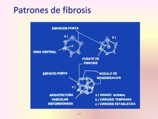 mbf
Patrones de fibrosis
 