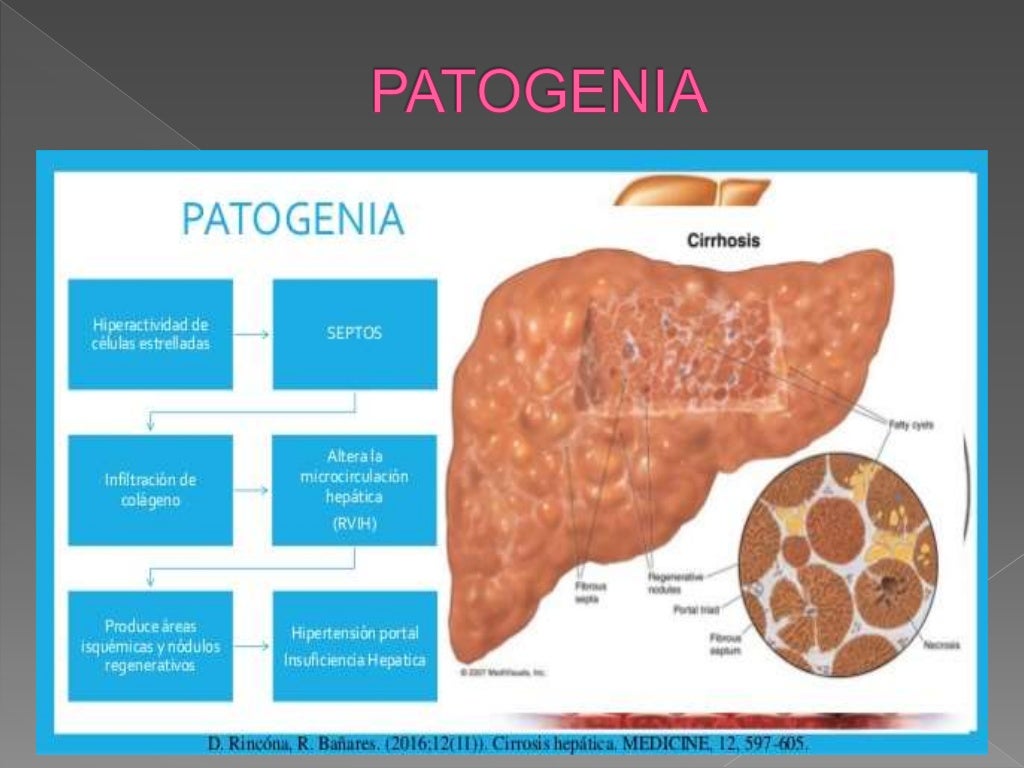 Cirrosis hepática Dr.Ugarte