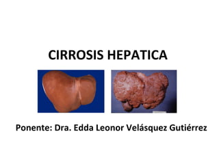 CIRROSIS HEPATICA



Ponente: Dra. Edda Leonor Velásquez Gutiérrez
 