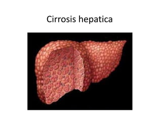 Cirrosis hepatica
 
