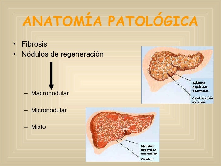 Cirrosis hepatica y complicaciones Cirrosis hepatica y complicaciones
