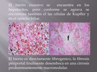 El hierro excesivo se encuentra en los
hepatocitos, pero conforme se agrava se
encontrara también el las células de Kupffer y
en el epitelio biliar.
El hierro es directamente fibrogenico, la fibrosis
periportal finalmente desemboca en una cirrosis
predominantemente macronodular.
 