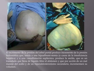 El incremento de la presión del árbol portal produce incremento de la presión
hidrostática que, unida a una hipoalbumi-nemia (a causa de la insuficiencia
hepática) y a una vasodilatación esplácnica, produce la ascitis, que es un
trasudado que llena de líquido libre el abdomen y que por acción de un mal
manejo del sodio y de un hiperaldosteronismo secundario, incrementará su
volumen.
 