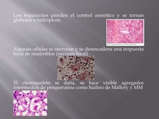 Los hepatocitos pierden el control osmótico y se tornan
globosos e hidrópicos.
Algunas células se necrosan y se desencadena una respuesta
focal de neutrofilos (necrosis focal)
El citoesqueleto se daña, se hace visible agregados
intermedios de prequeratina como hialino de Mallory y MM
 