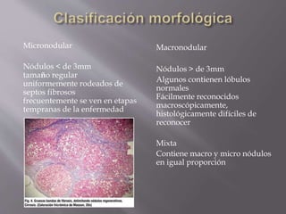 Micronodular
Nódulos < de 3mm
tamaño regular
uniformemente rodeados de
septos fibrosos
frecuentemente se ven en etapas
tempranas de la enfermedad
Macronodular
Nódulos > de 3mm
Algunos contienen lóbulos
normales
Fácilmente reconocidos
macroscópicamente,
histológicamente difíciles de
reconocer
Mixta
Contiene macro y micro nódulos
en igual proporción
 