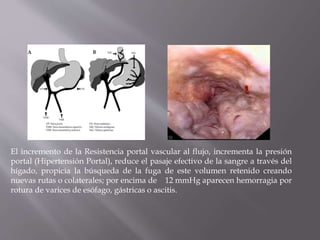 El incremento de la Resistencia portal vascular al flujo, incrementa la presión
portal (Hipertensión Portal), reduce el pasaje efectivo de la sangre a través del
hígado, propicia la búsqueda de la fuga de este volumen retenido creando
nuevas rutas o colaterales; por encima de 12 mmHg aparecen hemorragia por
rotura de varices de esófago, gástricas o ascitis.
 