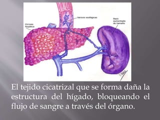 El tejido cicatrizal que se forma daña la
estructura del hígado, bloqueando el
flujo de sangre a través del órgano.
 