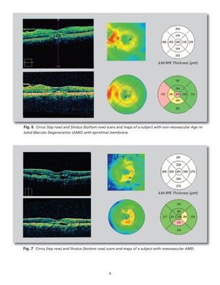 6
Fig. 6 Cirrus (top row) and Stratus (bottom row) scans and maps of a subject with non-neovascular Age re-
lated Macular Degeneration (AMD) with epiretinal membrane.
Fig. 7 Cirrus (top row) and Stratus (bottom row) scans and maps of a subject with noeovascular AMD.
ILM-RPE Thickness (µm)
ILM-RPE Thickness (µm)
 