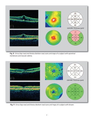 7
Fig. 8 Cirrus (top row) and Stratus (bottom row) scans and maps of a subject with epiretinal
membrane and macular edema.
Fig. 9 Cirrus (top row) and Stratus (bottom row) scans and maps of a subject with drusen.
ILM-RPE Thickness (µm)
ILM-RPE Thickness (µm)
 