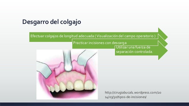 Cirugía oral - INCISION Y COLGAJO