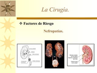 La Cirugía.
 Factores de Riesgo
Nefropatías.
 