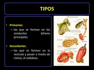 TIPOS

• Primarios:
   – los que se forman en los
     conductos         biliares
     principales.

• Secundarios:
   – l...