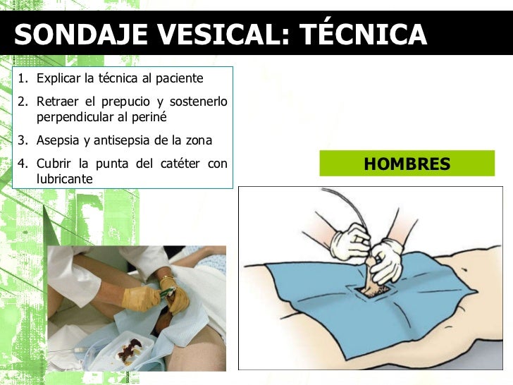 Técnica de cateterismo vesical