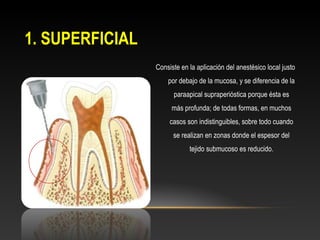 1. SUPERFICIAL
Consiste en la aplicación del anestésico local justo
por debajo de la mucosa, y se diferencia de la
paraapical supraperióstica porque ésta es
más profunda; de todas formas, en muchos
casos son indistinguibles, sobre todo cuando
se realizan en zonas donde el espesor del
tejido submucoso es reducido.
 