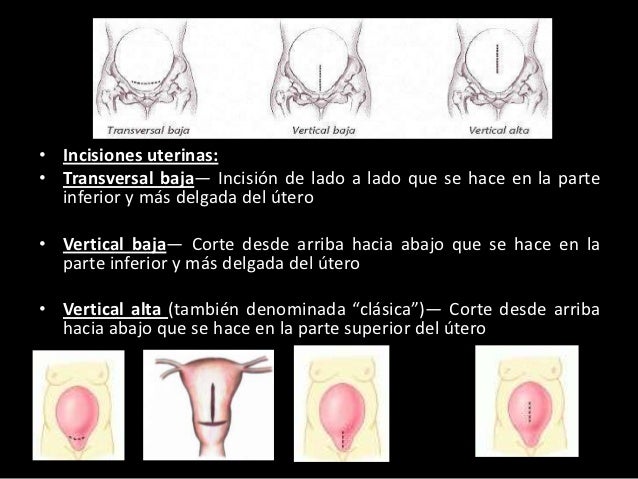 Cirugía cesárea