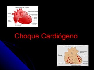 Choque Cardiógeno   