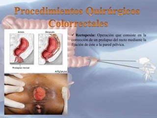  Protocolectomia: Extirpación
quirúrgica de todo el colon y el recto.
Las dos indicaciones más frecuentes son
la colitis ...